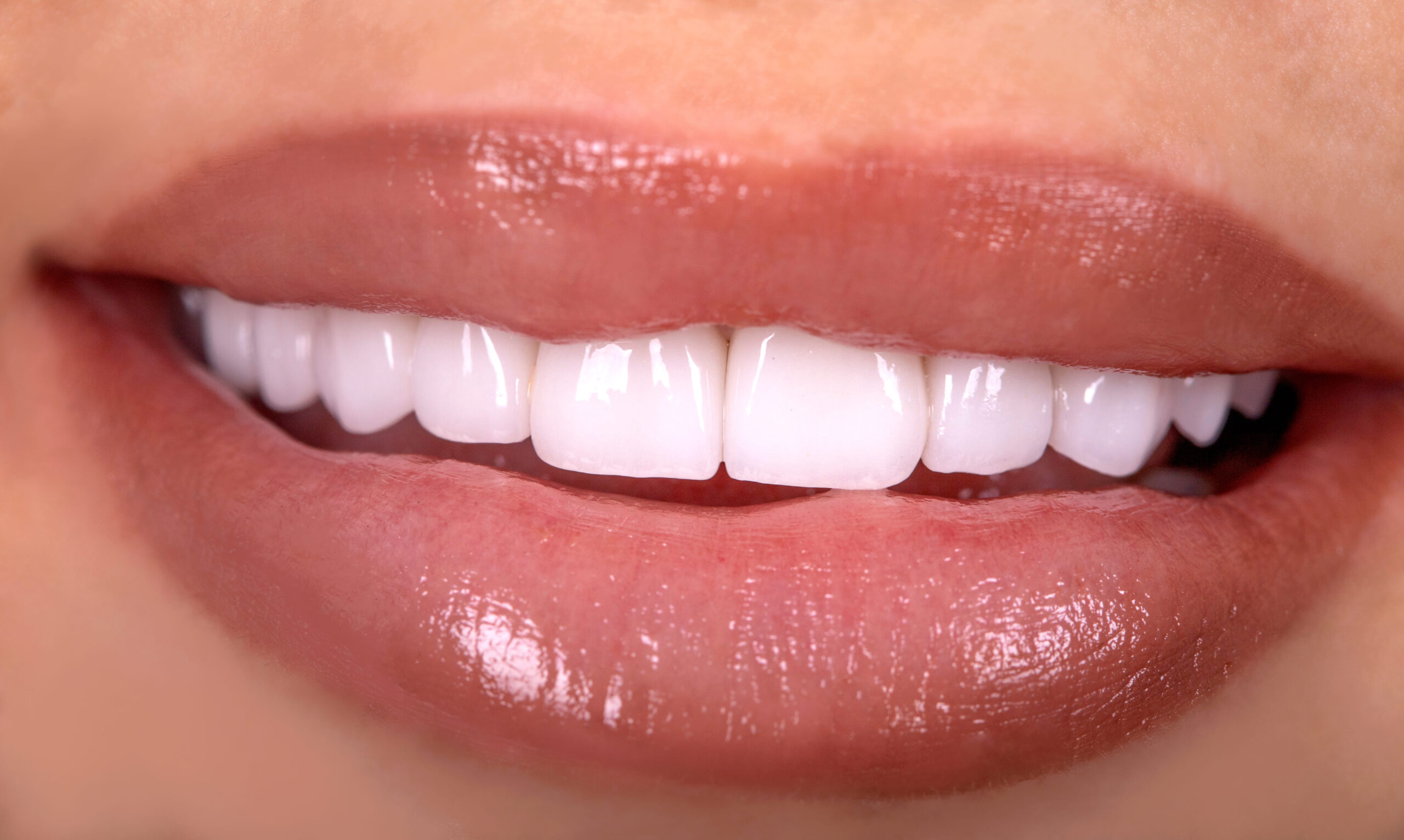 Lentes de contato dental