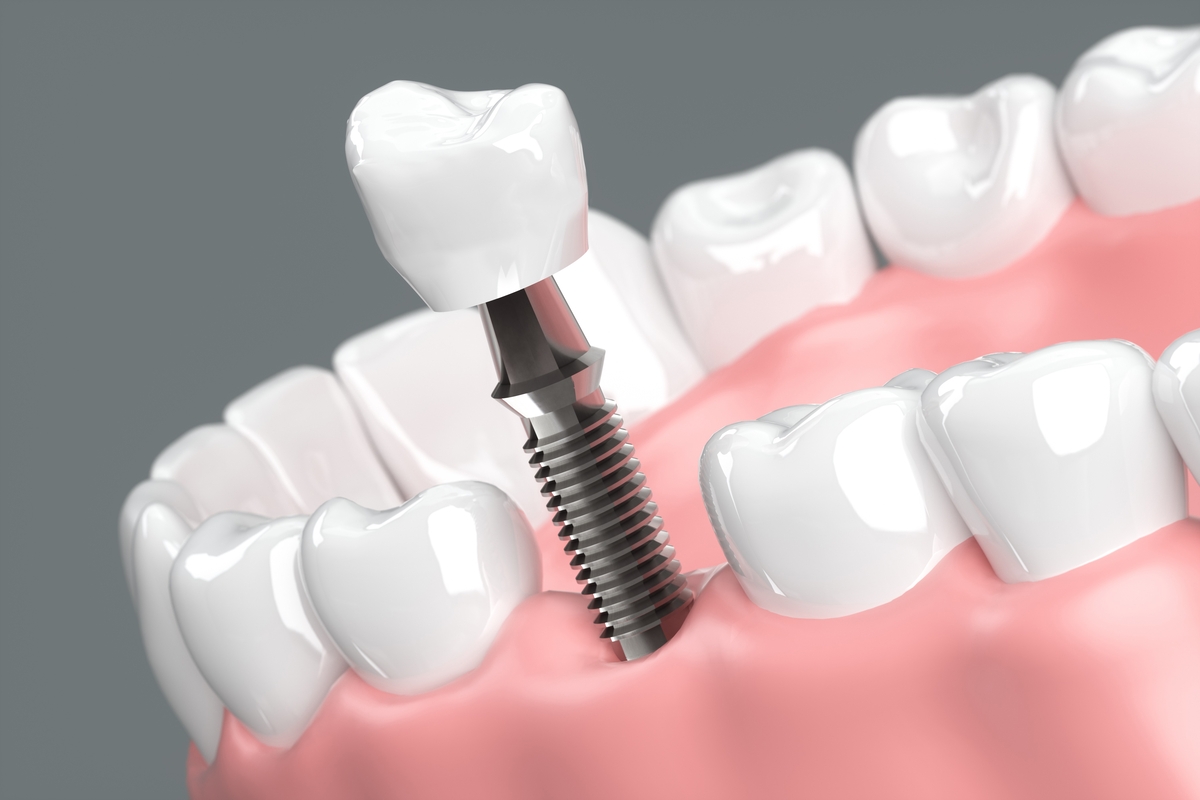 Implantes